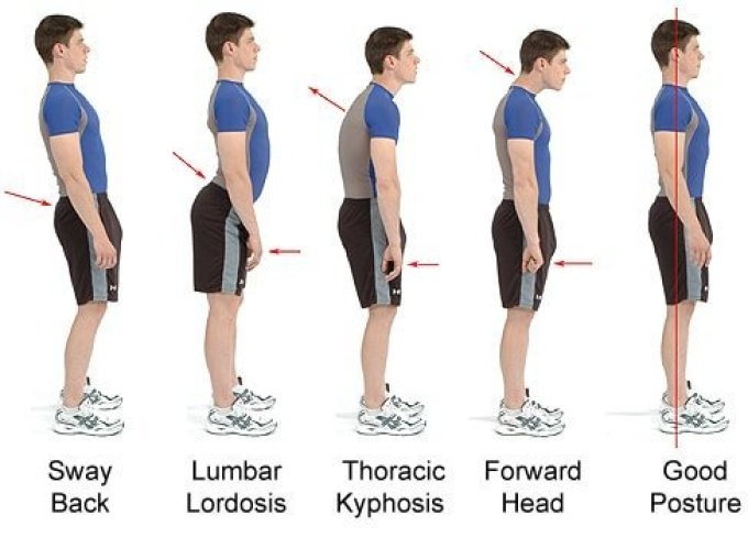 good postures and various types of poor posture 