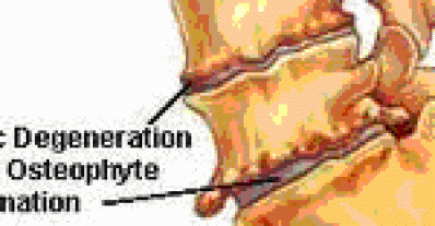 Bone spur, degenerative disc disease and arthritis