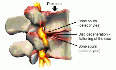 Bone spurs are nasty because they pinch your nerves. 