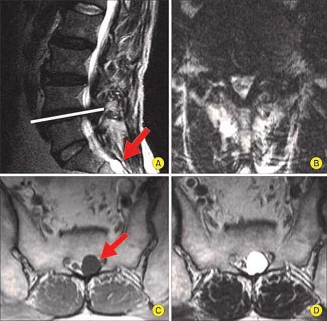 MRI diagnosis of tarlov cyst