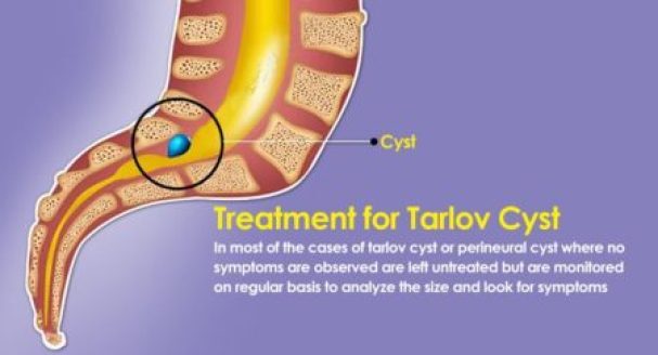 illustration showing tarlov cyst in tailbone (sacrum)