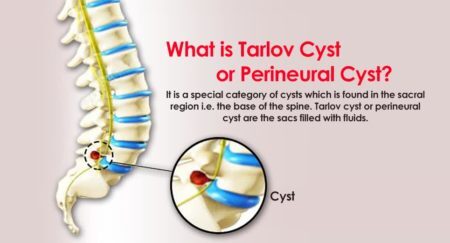 tarlov cyst or perineural cyst