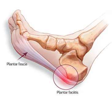 plantar fascia in flexed foot with plantar fasciitis 