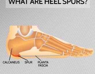 calcaneal heel spur