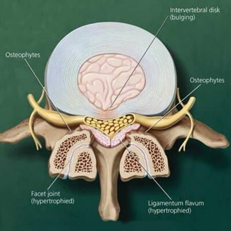 top view of ligamentum flavum location in the spine 