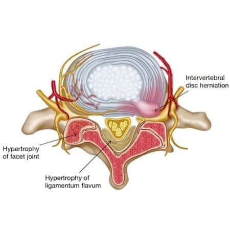 herniated disc & ligamentum flavum thickening causing canal stenosis 