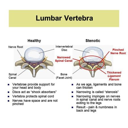 comparison view o normal and stenotic spinal canal 