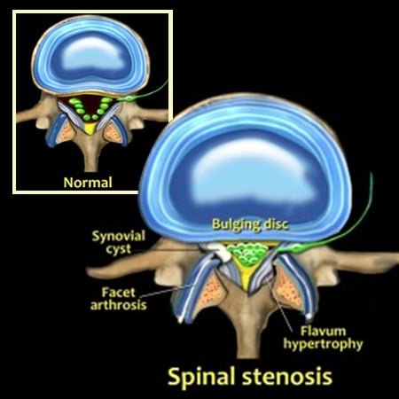 canal stenosis caused by ligamentum flavum thickening & hypertrophy