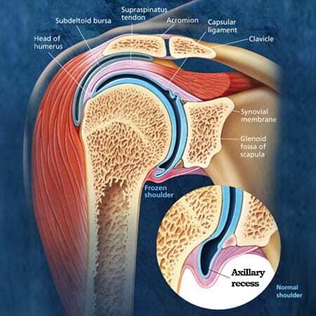 adhesive capsulitis in frozen shoulder
