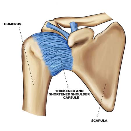 damaged shoulder capsule and ligament cause of frozen shoulder