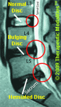 Disc herniation & disc bulge MRI side view 