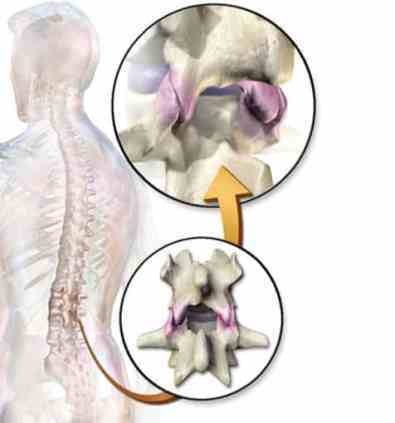  facet joints of the L4-L5 in the lumbar spine