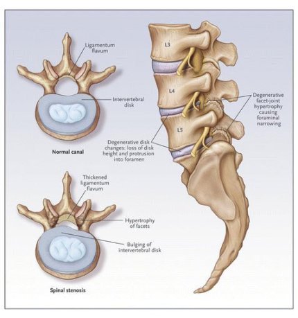 side and top view of spinal disc herniation and canal stenosis