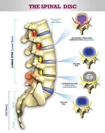 various types of spinal disc damage shown