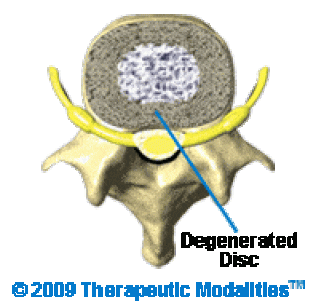 top view of degenerated disc 