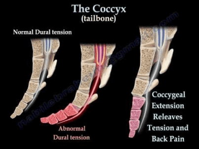 misalignment of coccyx bone or tailbone shown