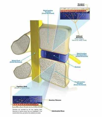How a spinal disc gets damaged shown in an illustration