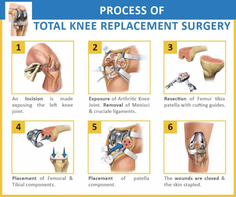 step-by-step illustration of knee replacement surgery TKR