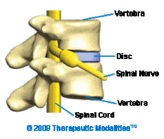 side view of spine with bulging disc shown