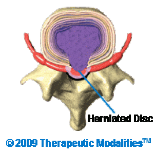 top view of moderate disc herniation