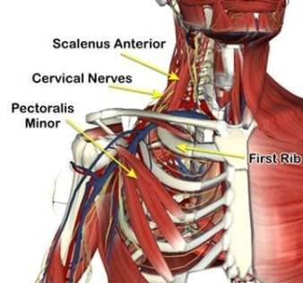 thoracic outlet syndrome causes shown