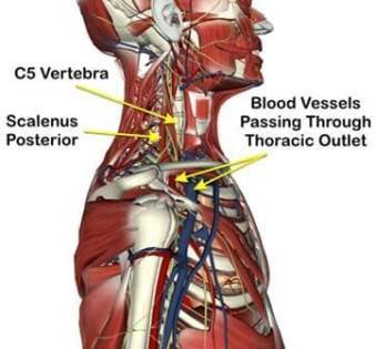 Illustration of muscular cases of thoracic outlet syndrome 