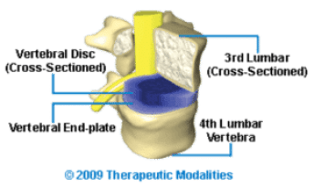 Cross section of L4-L5 spinal disc & spinal Joint shown