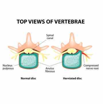top view of herniated and normal disc for comparison