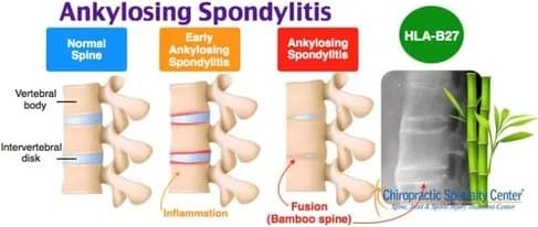 ankylosing spondylitis stages and HLA-B27 blood test for it