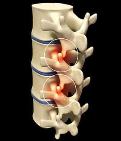 spinal joints cause upper back pain