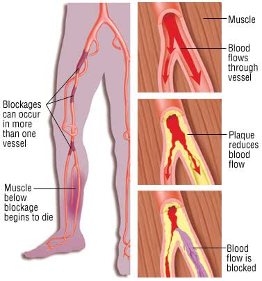 vascular sclerosis and plaquing in lower limbs