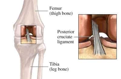 Posterior Cruciate Ligament Injury