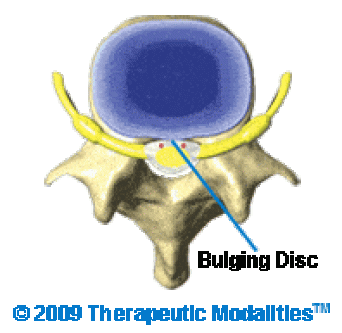 a bulging disc top view