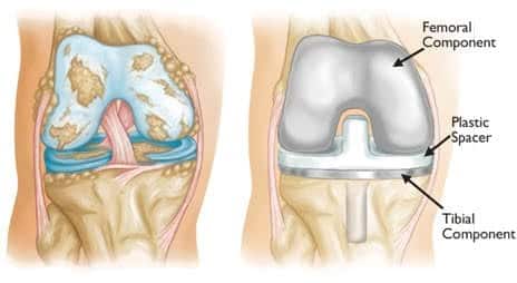 Knee replacement or TKR shown