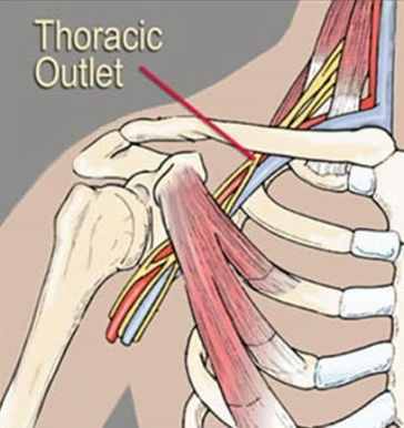 illustration of thoracic oulett area