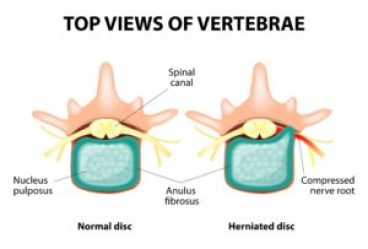 Top view of spine showing cause of upper back pain