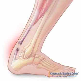 fully torn achilles tendon
