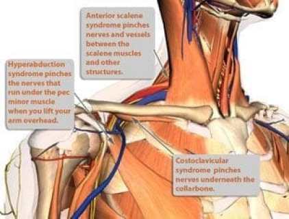 various causes of TOS or thoracic outlet syndrome shown