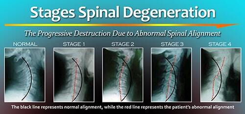 infographic on neck pain causes and degrative phases of neck problems caused by cervical spondylosis and disc degeneration