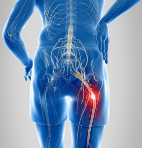Illustration of sciatica caused by compression of sciatic nerve